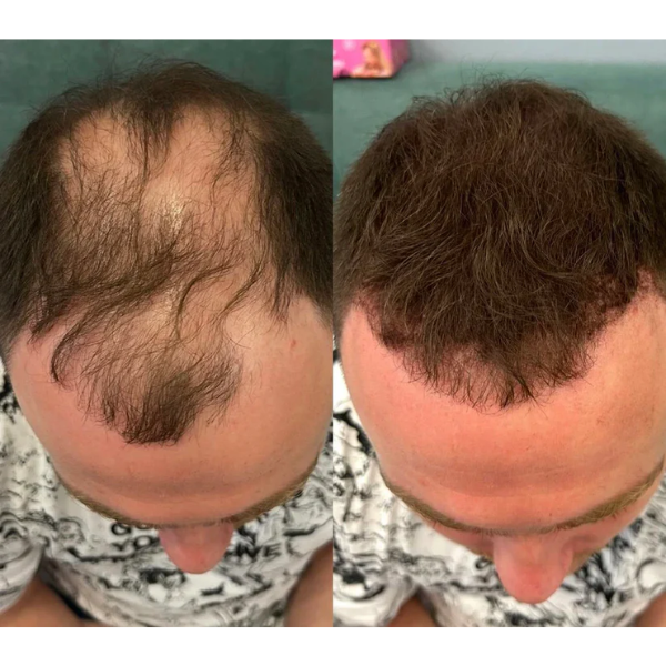 Apex Hair™ – Professional Hair Camouflage