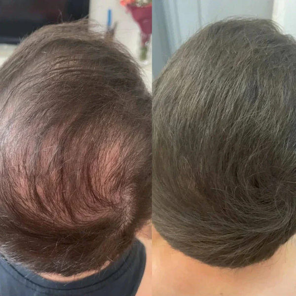 Apex Hair™ – Professional Hair Camouflage