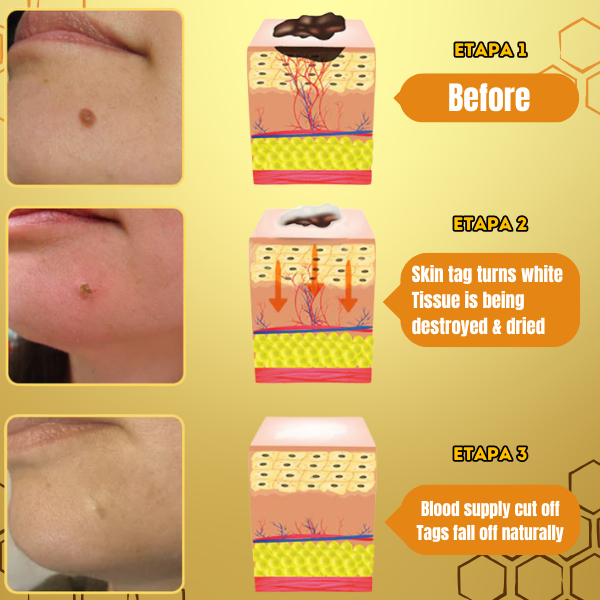 BeePure™ - 7-Day Wart Removal Treatment 🐝