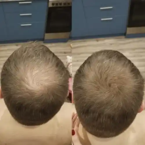 Apex Hair™ – Professional Hair Camouflage